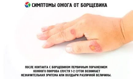 Burn Лечение хераклеум Burn Лечение хераклеум