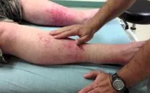 Как да пиявица у дома