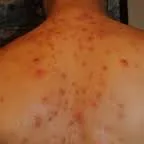 Пъпки по тялото, което е