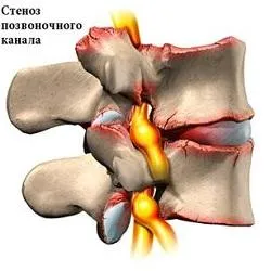 Какво е спинална стеноза