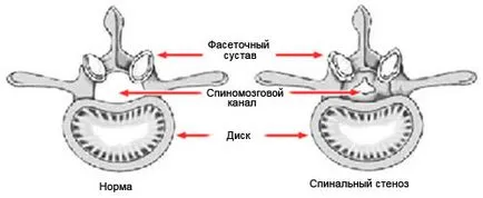 Какво е спинална стеноза