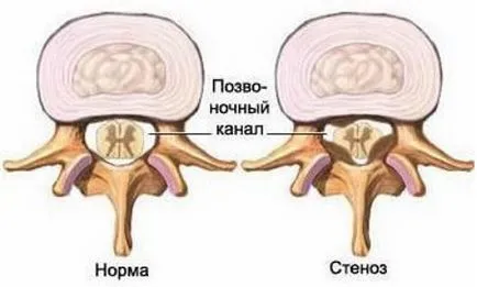 Какво е спинална стеноза