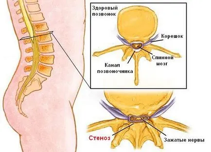 Какво е спинална стеноза