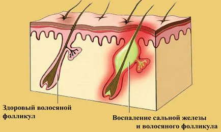 Акнето Лечение на лицето