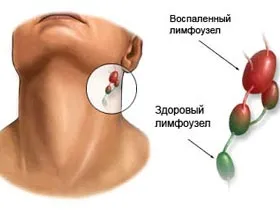 Какви са увеличени лимфни възли