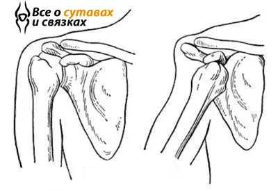 Как да се намали на рамото