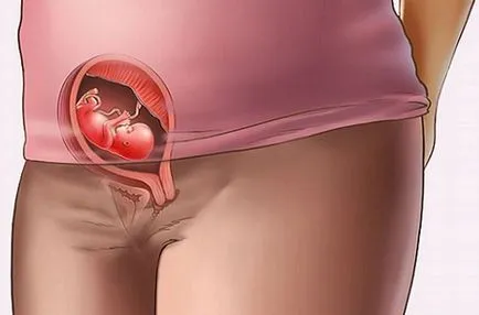Chlamydia и бременност лечение