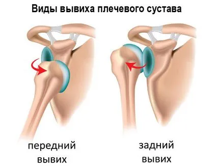 Как да се намали на рамото Как да се намали на рамото