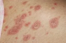 лечение живеница