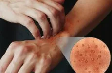 лечение живеница