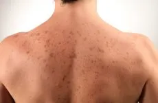 лечение живеница
