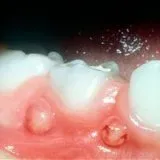 Какво е абсцес на венците