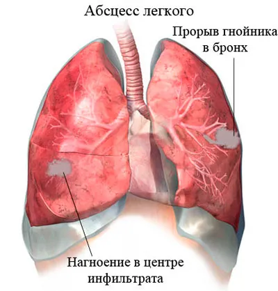 Абсцес на белия дроб, което е Абсцес на белия дроб, което е