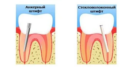 Какво е котва щифт