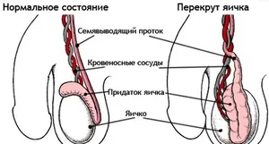 Възпалено крак в слабините, която е