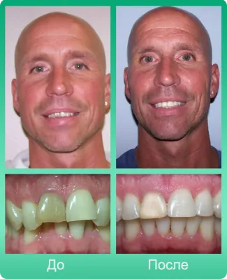 Снимки за скоби