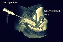 Какво ще се случи, ако има миома