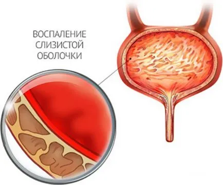 Цистит какво да правя