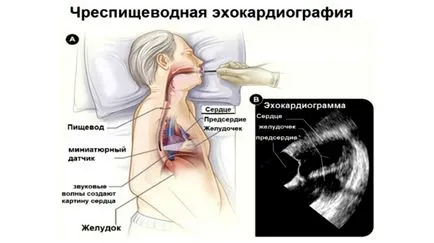 Какво е ехокардиография