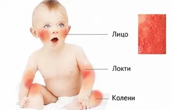 Than за лечение на диатеза при кърмачета