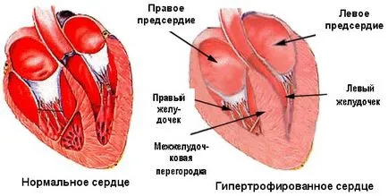 Лечение на хипертрофия на лявата камера на сърцето