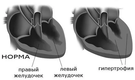 Лечение на хипертрофия на лявата камера на сърцето