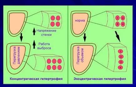 Лечение на хипертрофия на лявата камера на сърцето