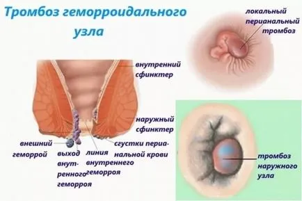Хемороиди Лечение по време на бременност