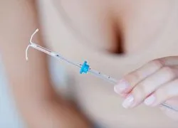 Вътрематочното Хормонални спирала