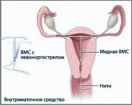 Вътрематочното Хормонални спирала
