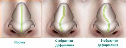 Корекция на носната преграда като