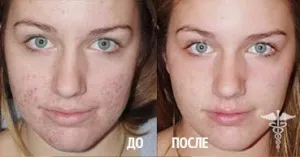Как да се отървете от акне помощ