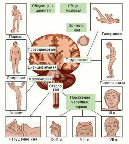 Как е енцефалит