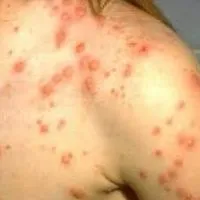 Откъде знаете, че имате варицелата
