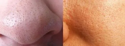 Какво е петното на акне