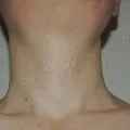 Отзиви от алергии като