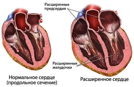 кардиомегалия го кардиомегалия го