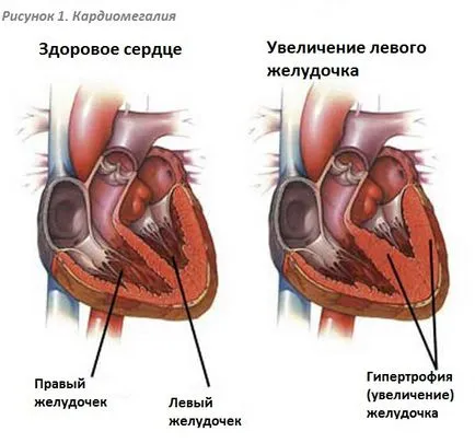 кардиомегалия го