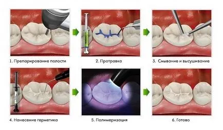 Запечатване (запечатване) фисура при деца, което е, цена, отзиви