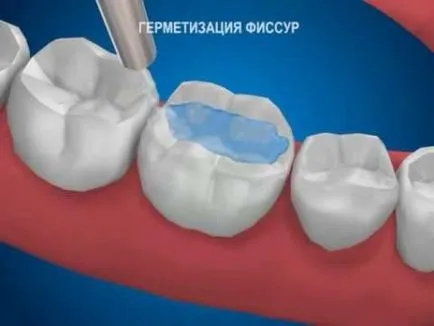 Запечатване на зъбите при децата преглед дали да се направи запечатването на фисури нужда
