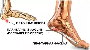 Как за лечение на шип Как за лечение на шип