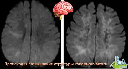 лечение на мозъка енцефалопатия