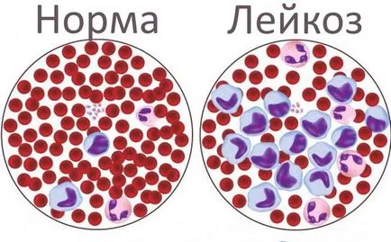 Какво е болестта на левкемия