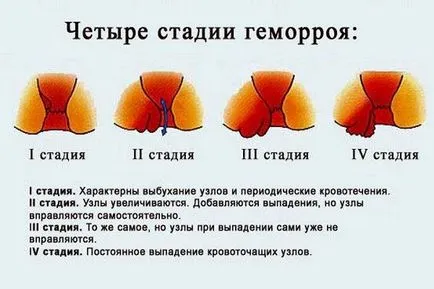 Хемороиди Лечение по време на бременност