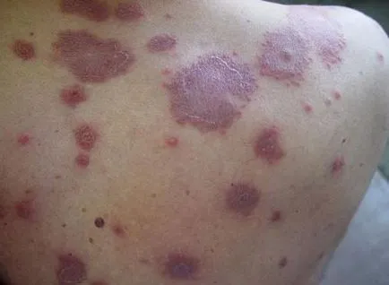 Какво е болестта на левкемия