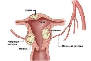 Какво ще се случи, ако има миома
