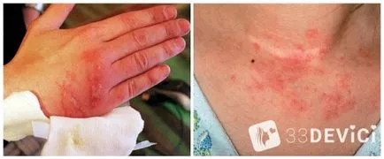 Как и какво лечение прополис