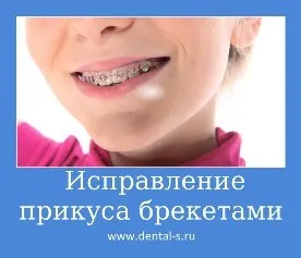 Изправяне на захапването, цената в Москва, техники, снимка, цената, сроковете