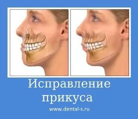 Изправяне на захапването, цената в Москва, техники, снимка, цената, сроковете