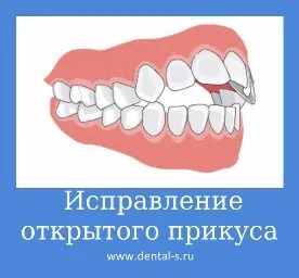 Изправяне на захапването, цената в Москва, техники, снимка, цената, сроковете